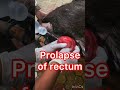 Prolapse Of Rectum L Dr Umar Khan