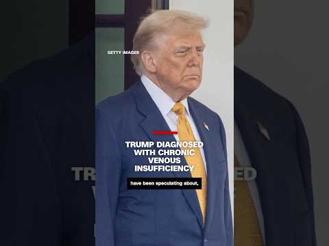 特朗普被診斷為慢性靜脈功能不全 (Trump diagnosed with chronic venous insufficiency)