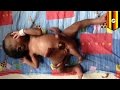 Близнец-паразит: в Уганде провели операцию ребёнку, родившемуся с четырьмя ...