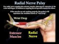 Radial Nerve Palsy, injury - WRIST DROP ...