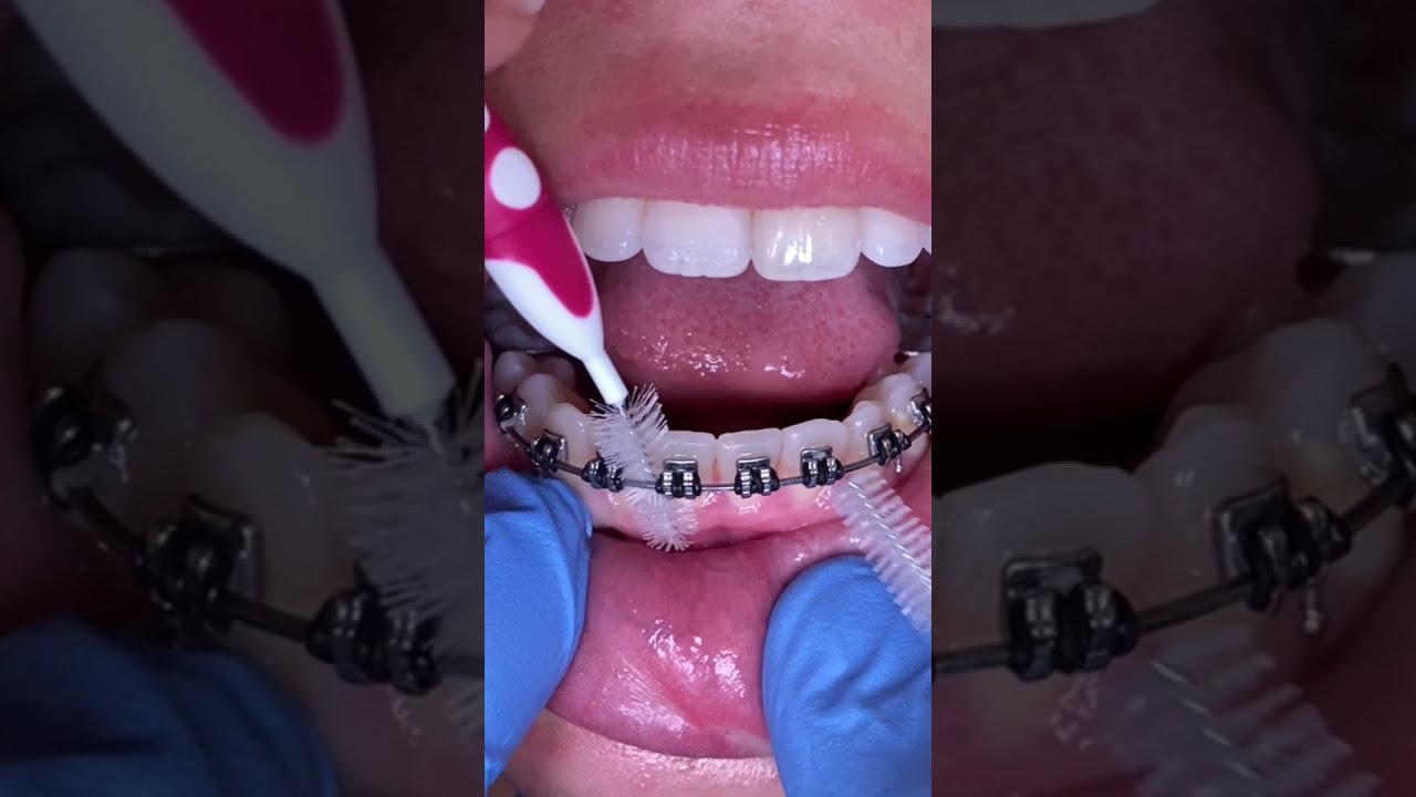 Interdental brushes (Tooth Bristles)  and Braces - Clean Braces at home Tooth Time Family Dentistry