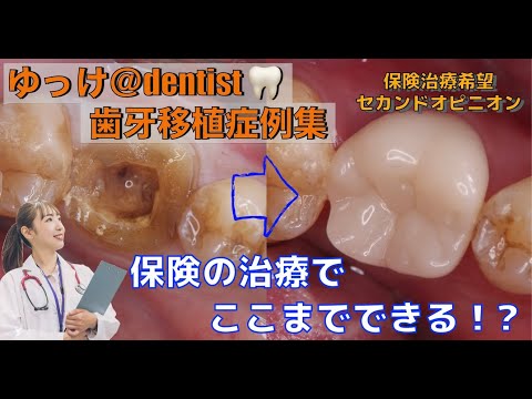 生命歯学科 【歯牙移植症例集】保険治療でここまでできる？抜歯宣告されたとき歯を残すことができる歯の移植🦷その治療法を大公開‼️入れ歯、ブリッジだけじゃない！保険でできる抜歯をした後の治療法をお教えします‼️