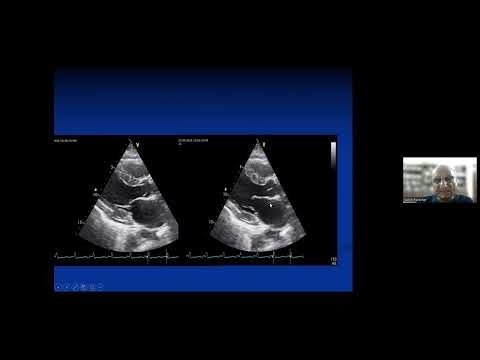 52nd 7th Session-Basics of Mitral stenosis Tricuspid Stenosis   How to do it  by Dr Col SK Parashar