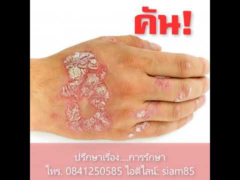 โรคสะเก็ดเงินและตังเมวิดีโอที่ดีที่สุด เกลือทะเลสามารถรักษากลาก