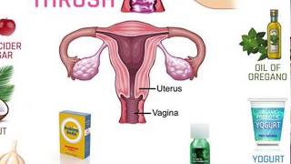 Home Remedies for Vaginal Thrush