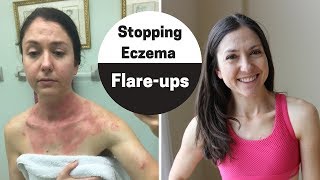 How to handle eczema flare-up (My 4 step checklist to clear skin)