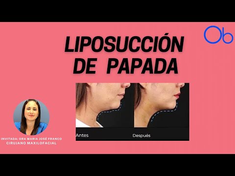 Liposucción de papada