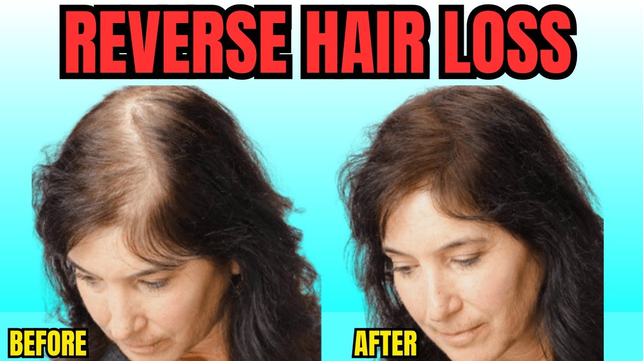 Hair Loss - Reverse Hair Loss Naturally