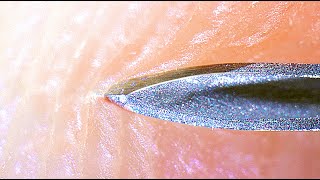 NEEDLE IN TO HUMAN SKIN - [under microscope]