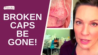 HOW TO REALLY REMOVE BROKEN CAPILLARIES