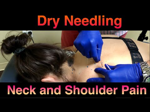 Dry Needling the Neck and Shoulder