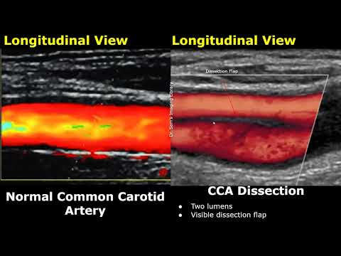 Carotid Artery Color/Spectral Doppler Ultrasound Normal Vs Abnormal Images | ICA Stenosis USG