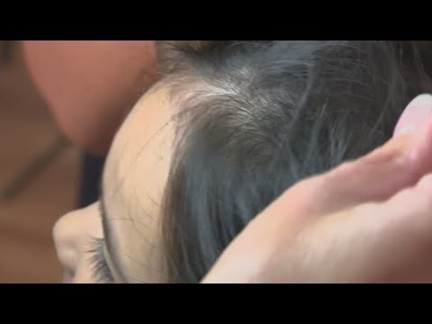 How to identify and treat head lice