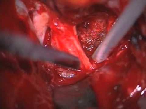 Endoscopically assisted transbasal and middle fossa extradural transcavernous approach 