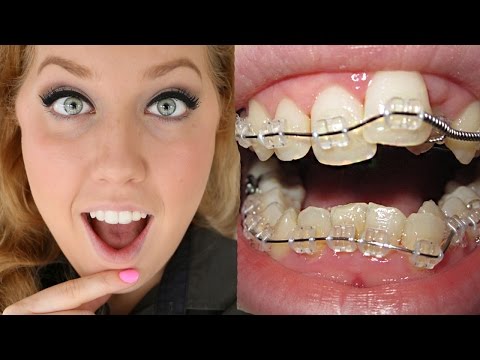 Braces Before And After | Timelapse Transformation | Ashley Craig