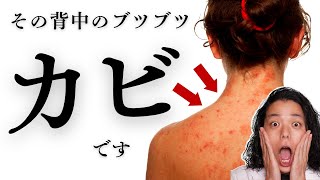 はじまり - 【背中ニキビを一掃!】効果的な改善方法を紹介!