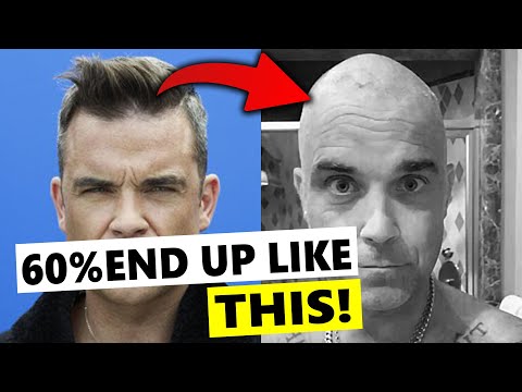 Hair Loss Always Defeats Transplant at The End!? Robbie Williams's Bad News