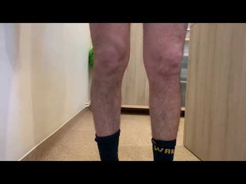 Artrita articulațiilor picioarelor 3 etape