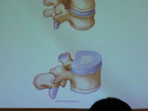 disco vertebral: anillo fibroso, núcleo pulposo