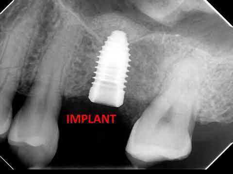How Dental Implant with Sinus Lift works?