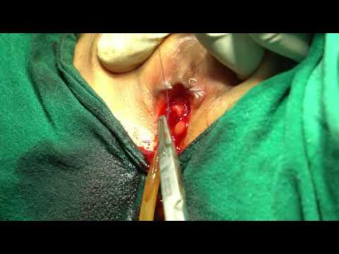 Demonstration of Urethral Mucosal Prolapse Excision