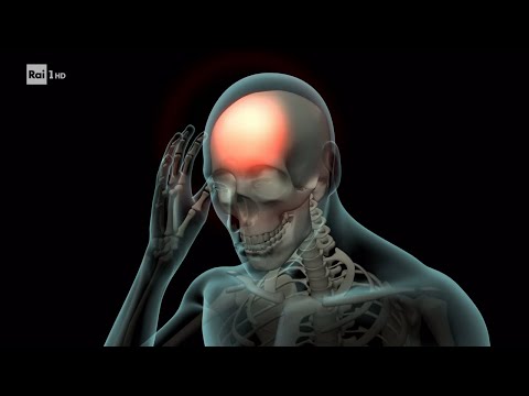 Obiettivo sul mal di testa - Superquark 06/07/2022