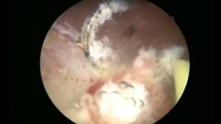 Διουρηθρική αφαίρεση θηλωμάτων