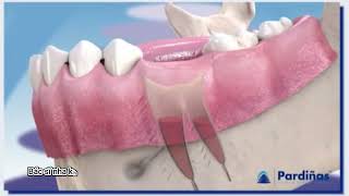 Ổ khô sau khi nhổ răng