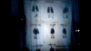 Surgical Radiology - 5 - basics of scintiscans