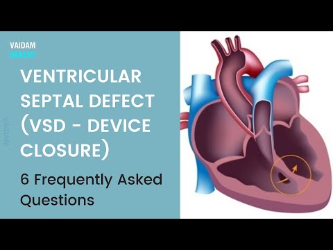 Ventricular septal defect(VSD)- 6 Frequently Asked Questions