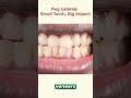 Can peg laterals be fixed without braces?