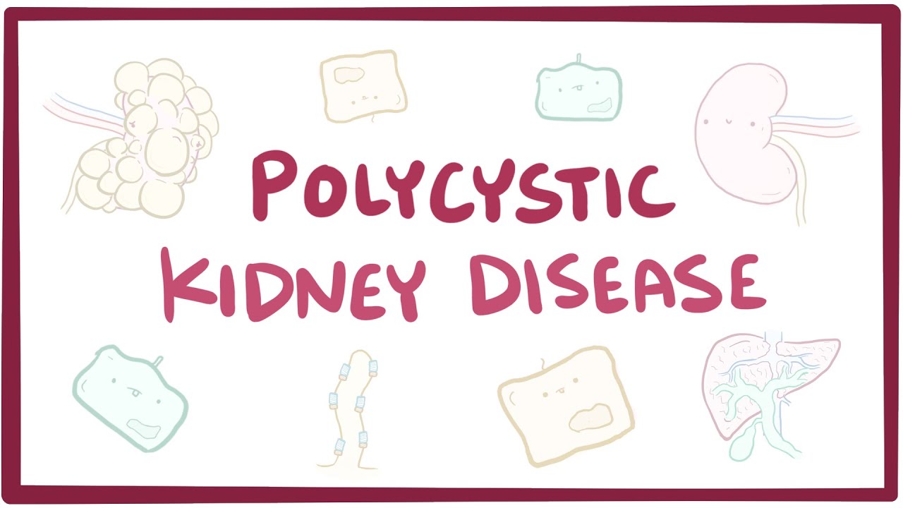 Polycystic kidney disease - causes, symptoms, diagnosis, treatment, pathology