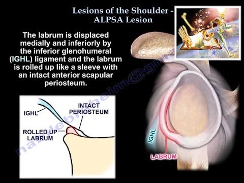 Lesions Of The Shoulder ALPSA lesion - Everything You Need To Know - Dr. Nabil Ebraheim