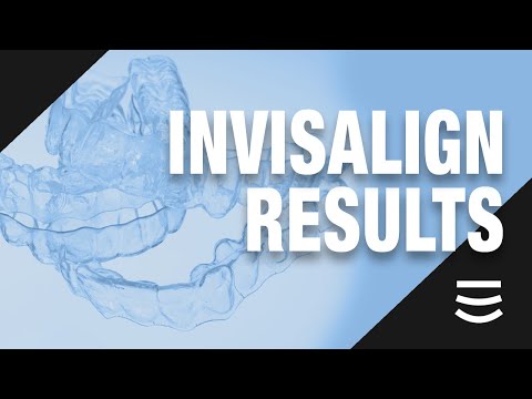 Invisalign Success at a Top North Carolina Dentist