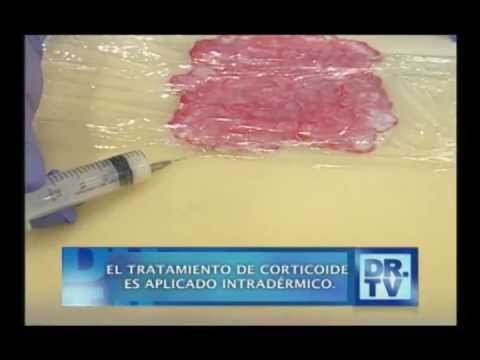 Los ungüentos modernos para el tratamiento de la psoriasis Avene a atopicheskom la dermatitis al niño