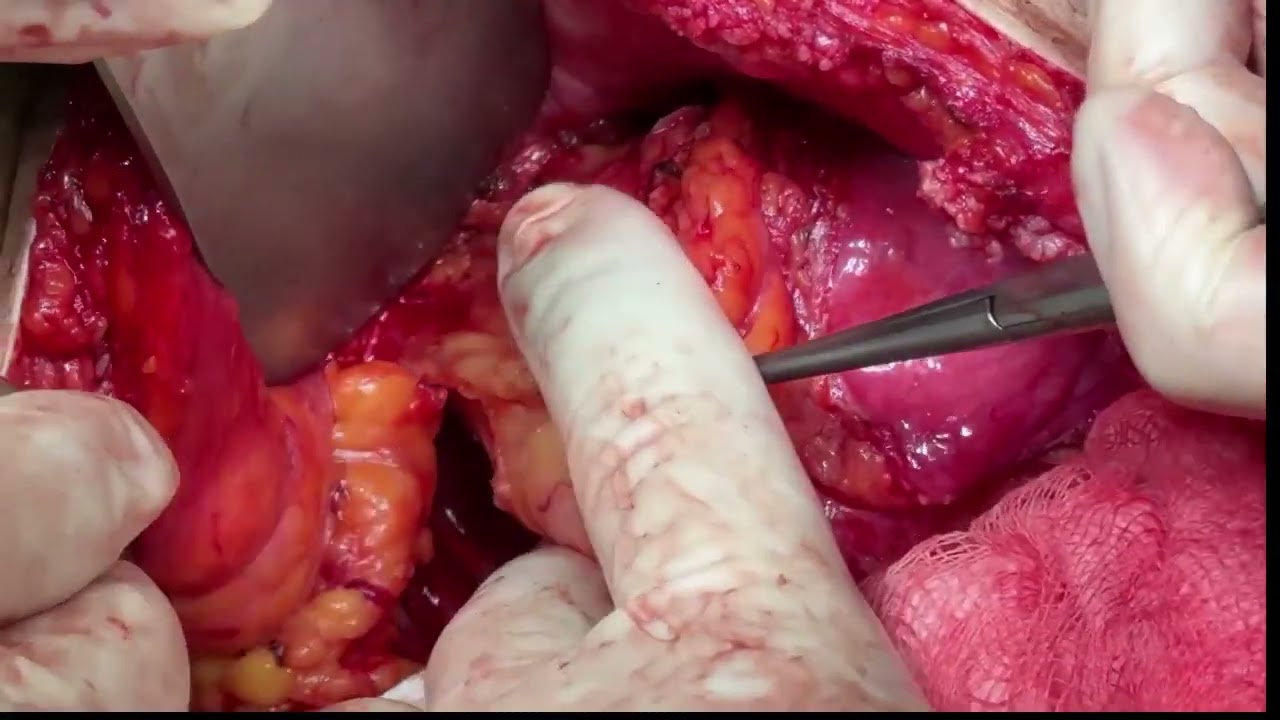 Surgery for Recurrent Colon Cancer