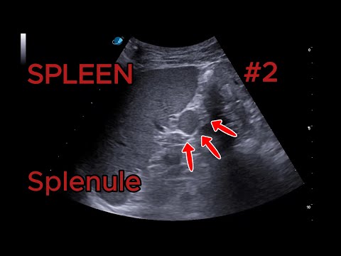 Accessory spleen video preview