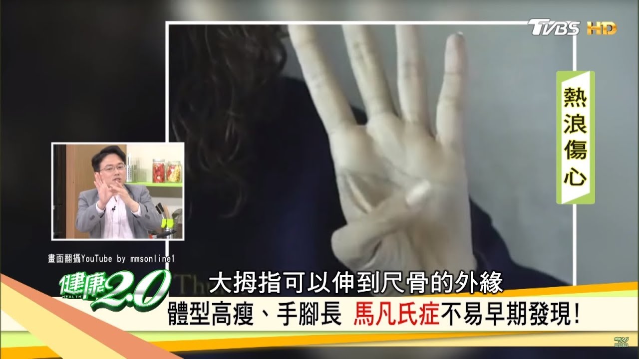 認識馬凡氏症! 手長、腳長、體型高瘦都是特徵