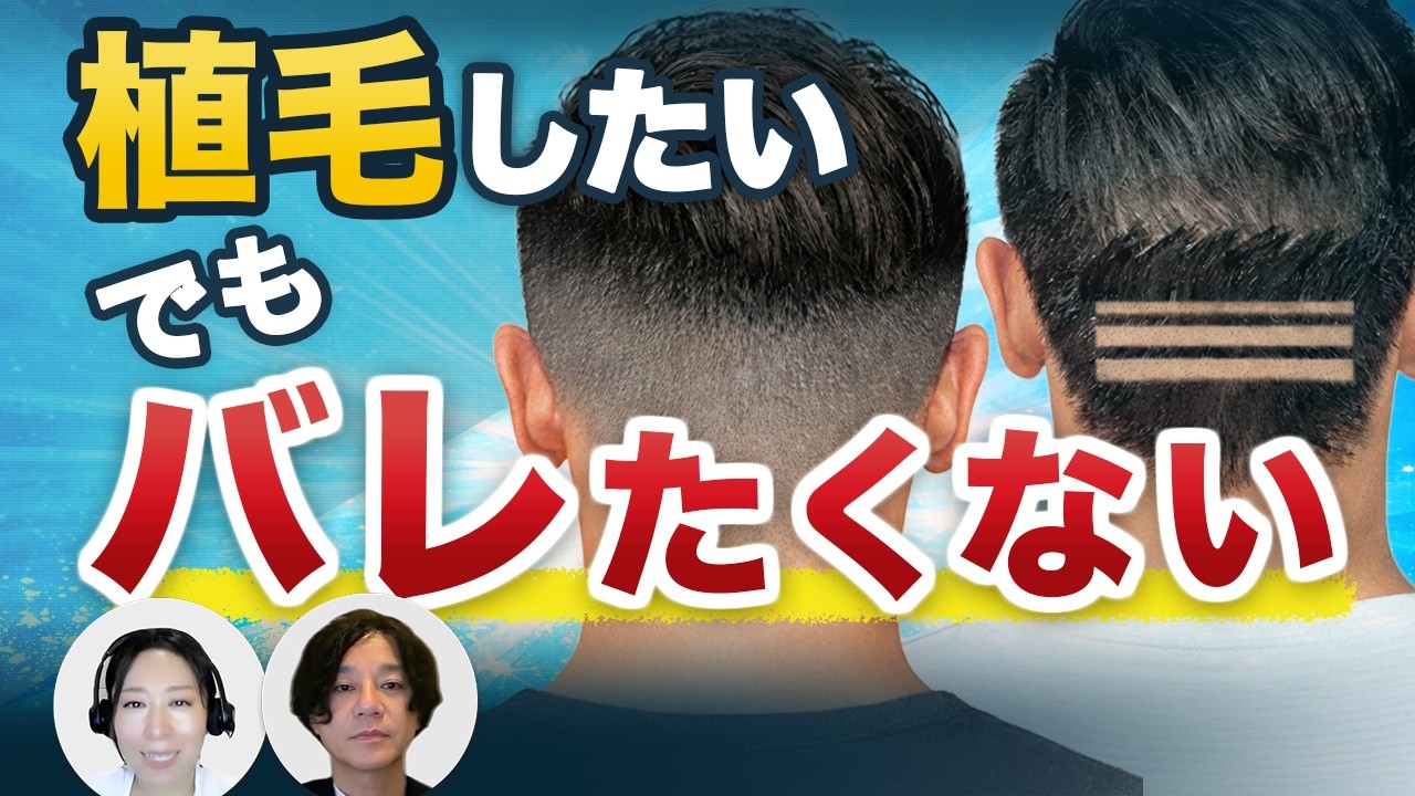 植毛したいけど職場でバレたくない｜バレにくい復帰の進め方を徹底解説