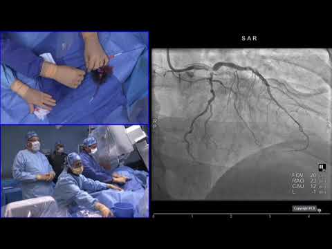 Complex PCI in high bleeding risk patients