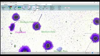 MMC Sperm: DNA fragmentation analysis