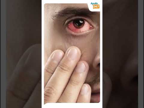 How do I Stop my Eyes from Watering Dr Shubhra Goel