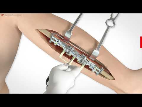 L1® Mandible ReconGuide (deutsch)
