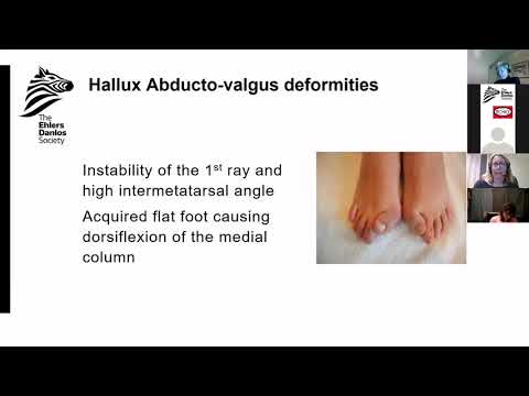 EDS ECHO Allied Health Professionals UK/Europe (P1), Session 2
