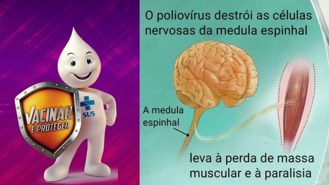 POLIOMIELITE -  Conteúdo Completo | Sintomas, Fatores de risco, Diagnóstico, Tratamento e Prevenção