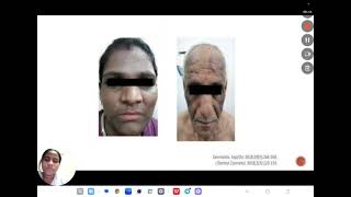 Allergic disorders Atopic dermatitis and contact dermatitis – Etiology, Clinical features, Diagnosis