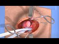 Inguinal hernia repair - 3D surgery animation
