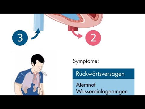 Herzinsuffizienz - Ödeme - Schleifendiuretika