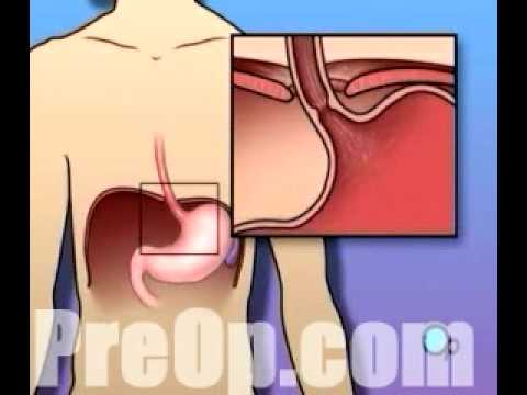 PreOp® Patient Education Hernia - Hiatal Open Repair 1.5