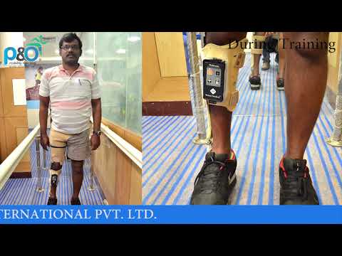 Ossur carbon dynamic afo ankle foot orthosis